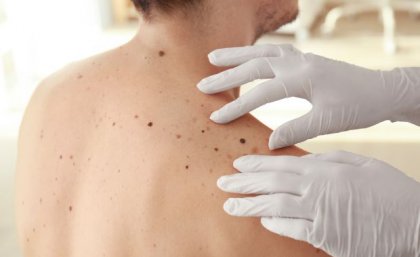 Gloved hands are on a person's bare back with fair skin, inspecting moles.